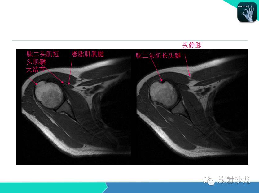 肩关节常见疾病的MRI表现