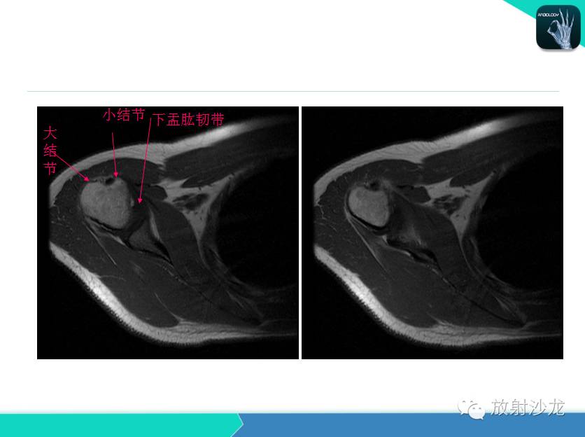 肩关节常见疾病的MRI表现