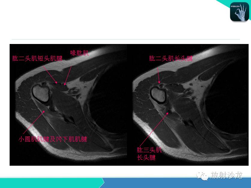 肩关节常见疾病的MRI表现