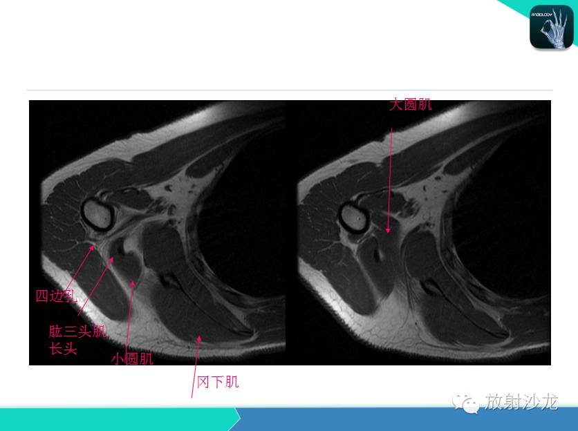 肩关节常见疾病的MRI表现