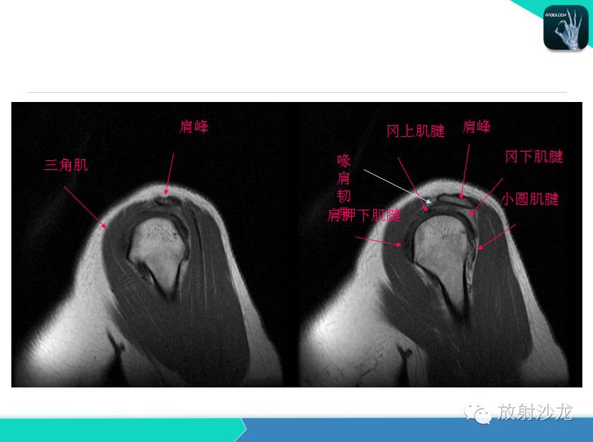 肩关节常见疾病的MRI表现