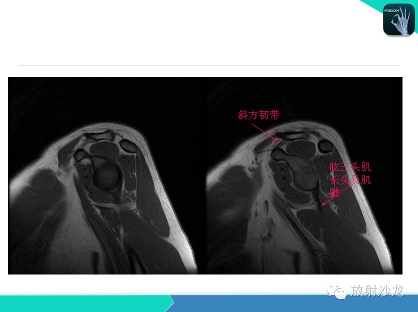 肩关节常见疾病的MRI表现