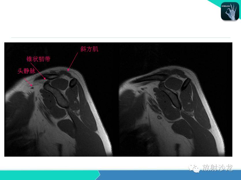 肩关节常见疾病的MRI表现