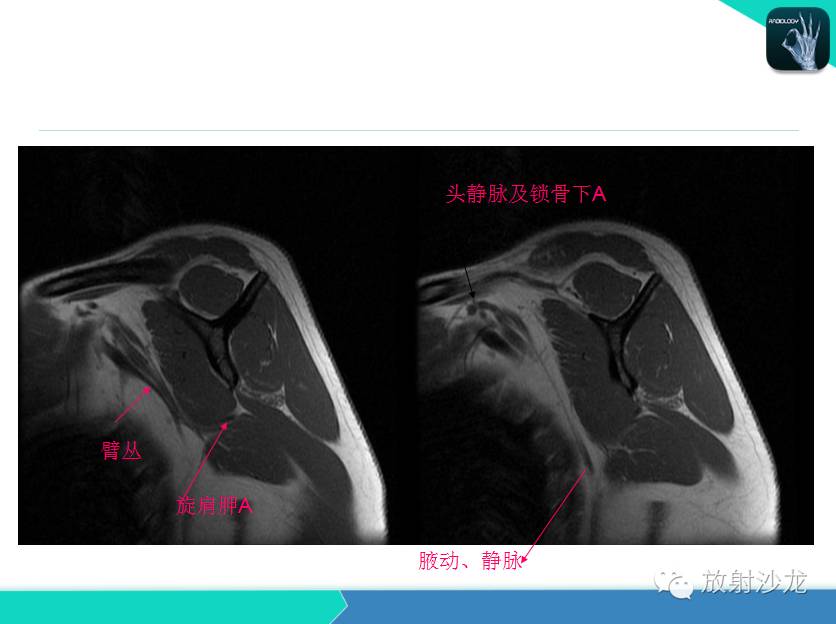 肩关节常见疾病的MRI表现