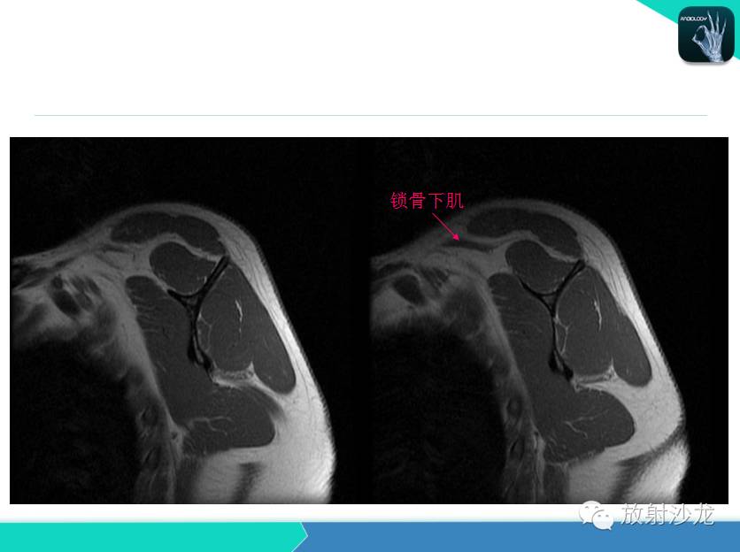 肩关节常见疾病的MRI表现
