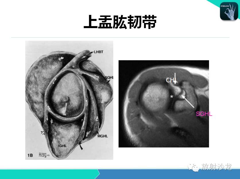 肩关节常见疾病的MRI表现