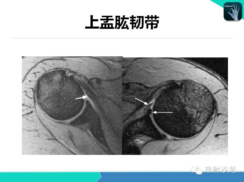 肩关节常见疾病的MRI表现