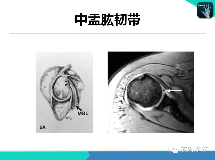 肩关节常见疾病的MRI表现