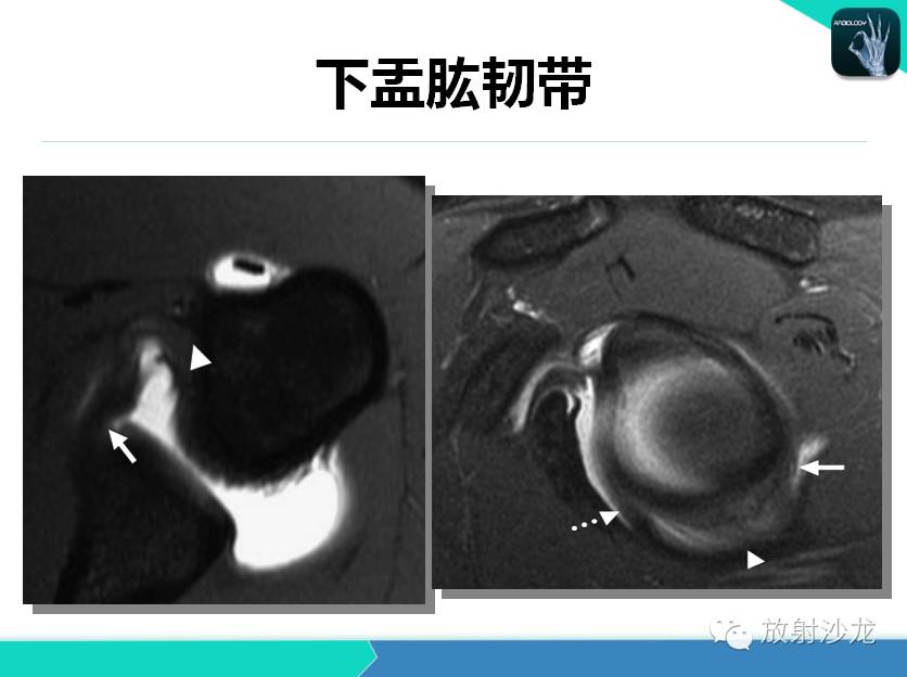 肩关节常见疾病的MRI表现