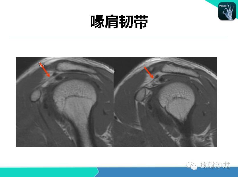 肩关节常见疾病的MRI表现