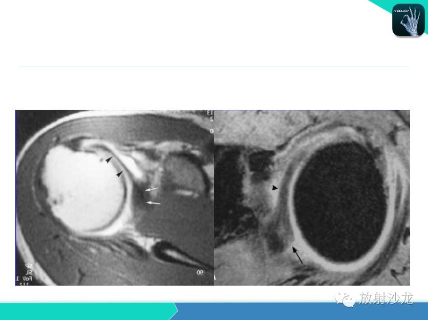 肩关节常见疾病的MRI表现