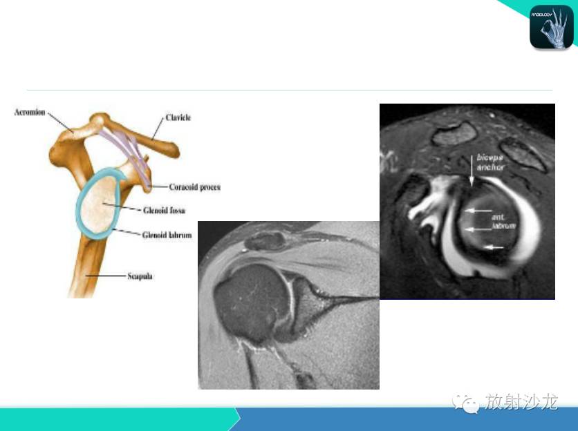 肩关节常见疾病的MRI表现