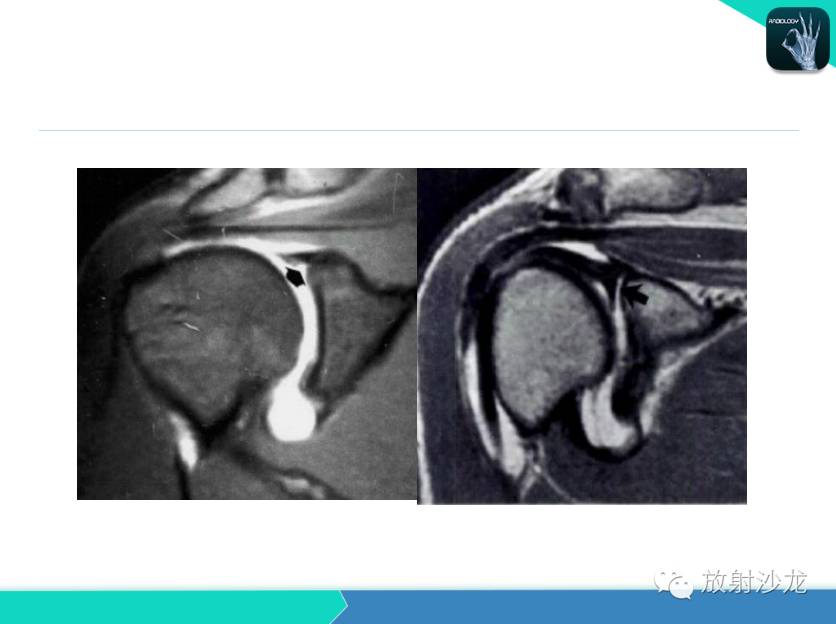 肩关节常见疾病的MRI表现