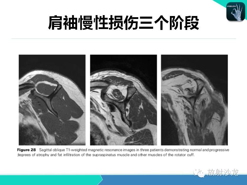 肩关节常见疾病的MRI表现