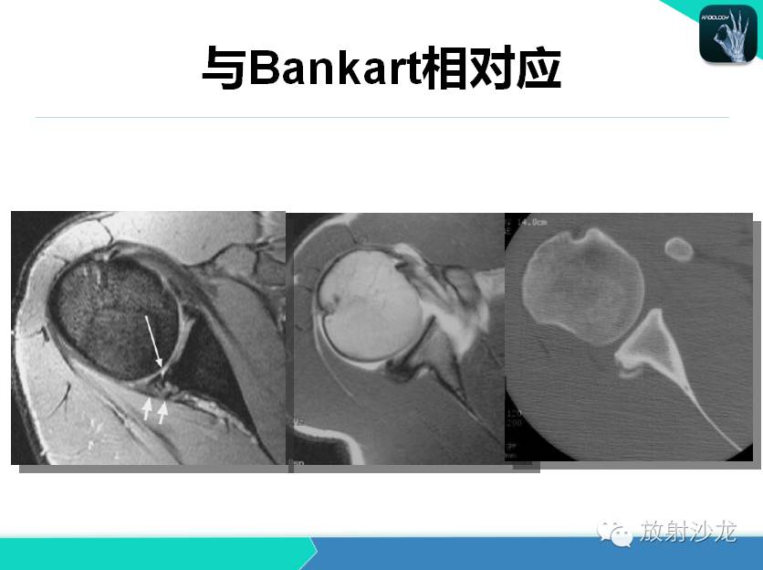 肩关节常见疾病的MRI表现