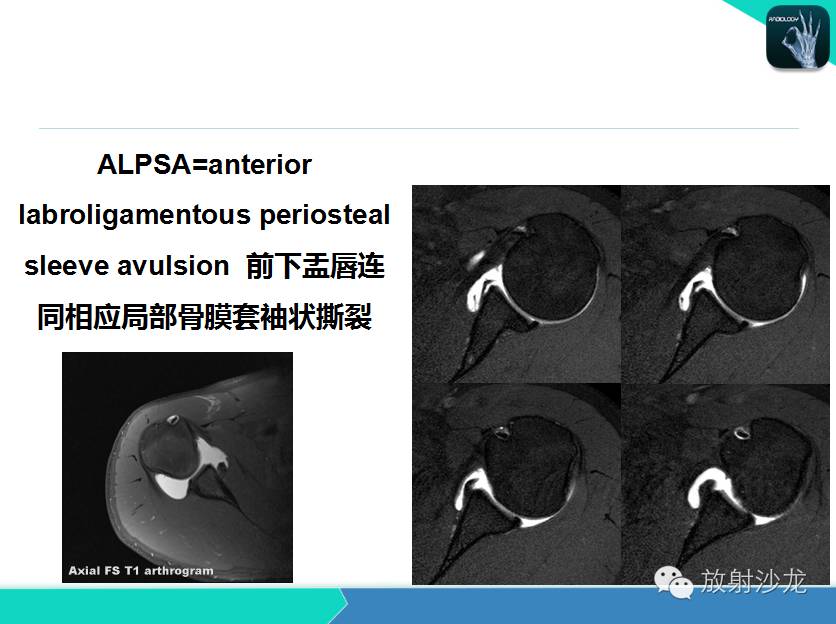 肩关节常见疾病的MRI表现