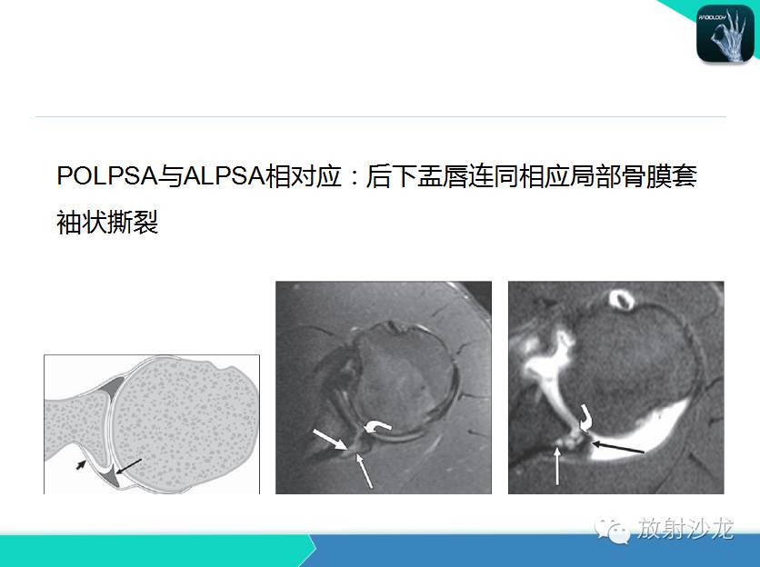 肩关节常见疾病的MRI表现