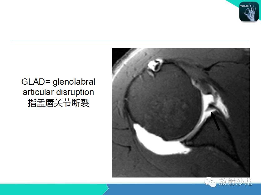 肩关节常见疾病的MRI表现