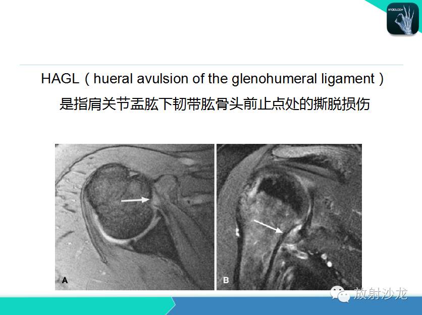 肩关节常见疾病的MRI表现