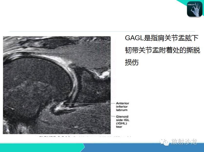 肩关节常见疾病的MRI表现