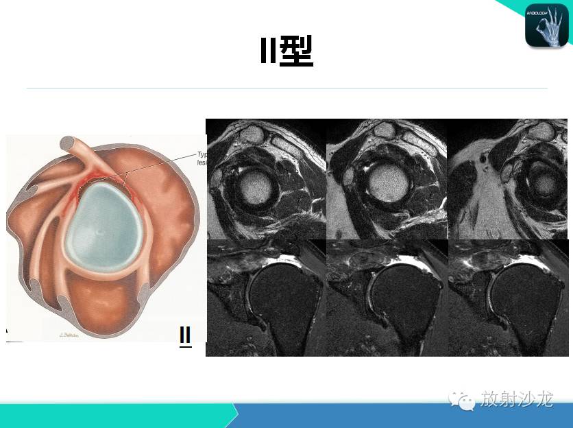肩关节常见疾病的MRI表现