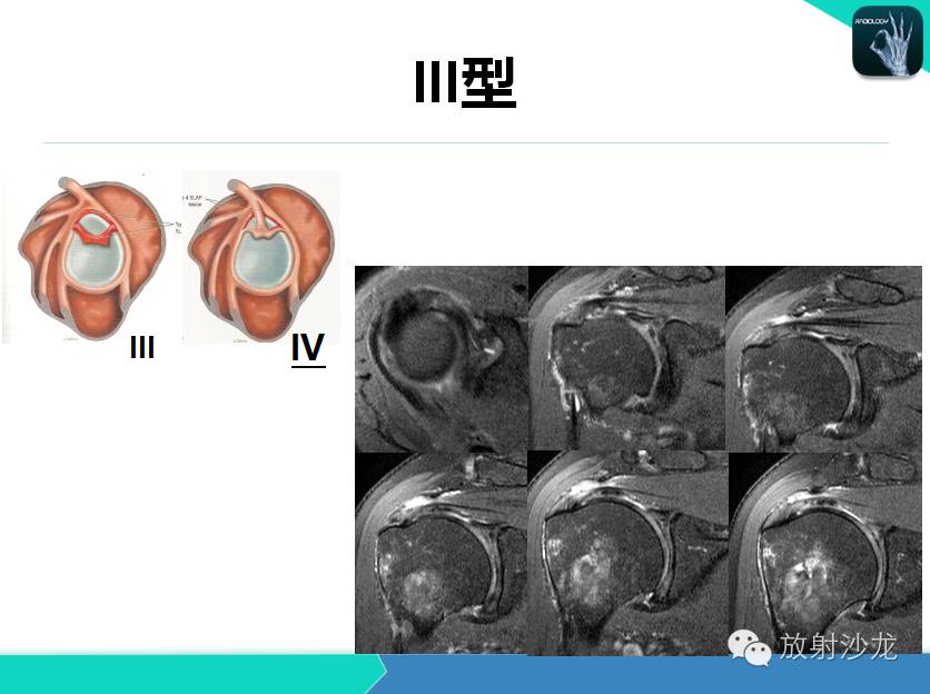 肩关节常见疾病的MRI表现