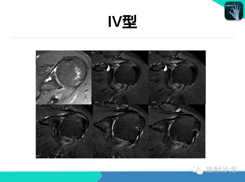 肩关节常见疾病的MRI表现
