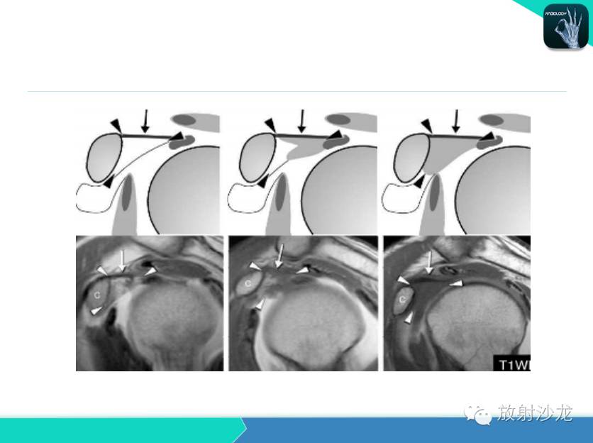 肩关节常见疾病的MRI表现
