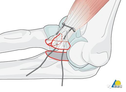 肘关节恐怖三联征的重建方法