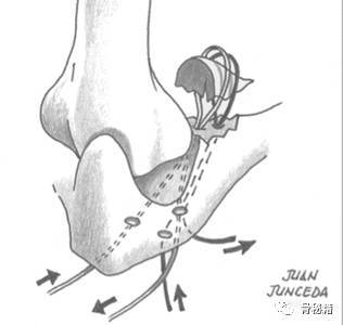 肘关节恐怖三联征的重建方法