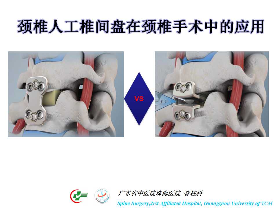 颈椎人工椎间盘在颈椎手术中的应用