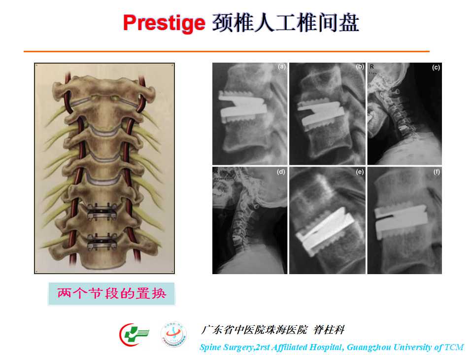 颈椎人工椎间盘在颈椎手术中的应用