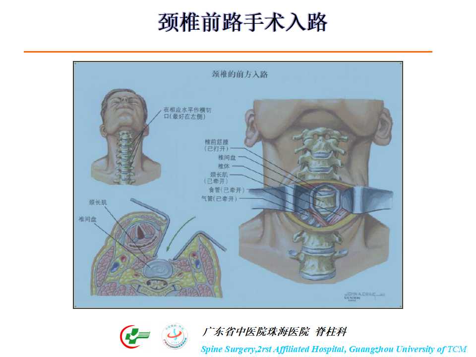 颈椎人工椎间盘在颈椎手术中的应用