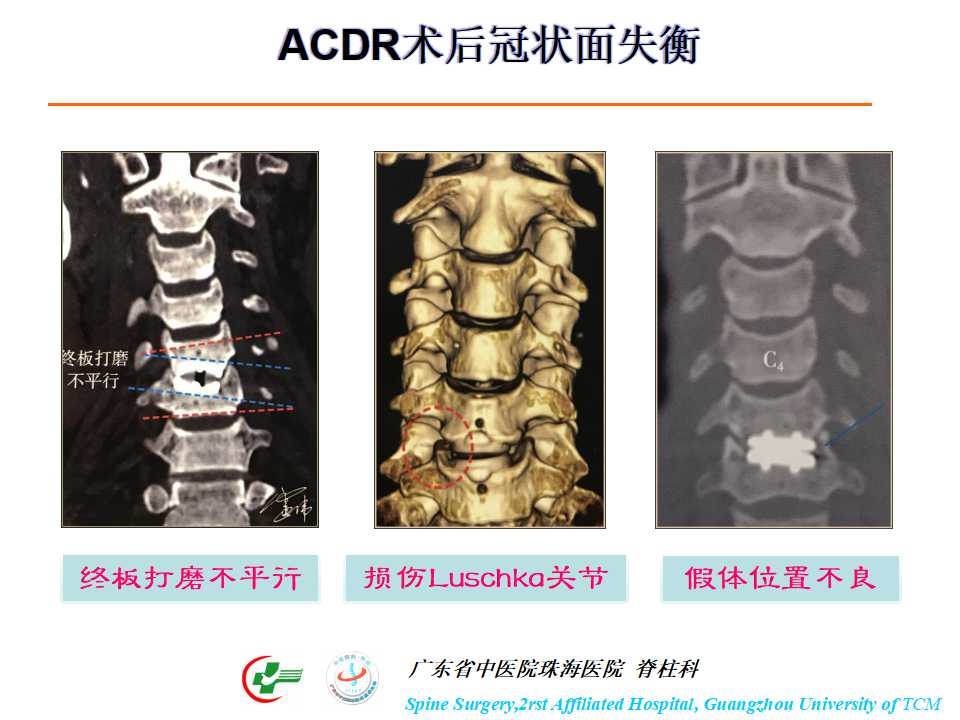 颈椎人工椎间盘在颈椎手术中的应用