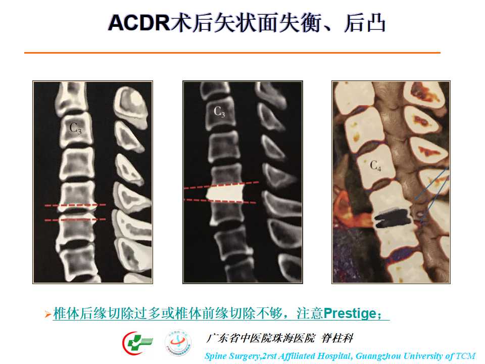 颈椎人工椎间盘在颈椎手术中的应用