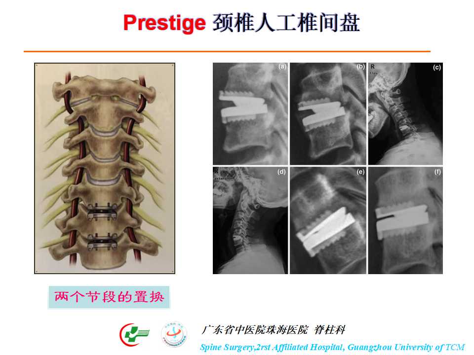 颈椎人工椎间盘在颈椎手术中的应用