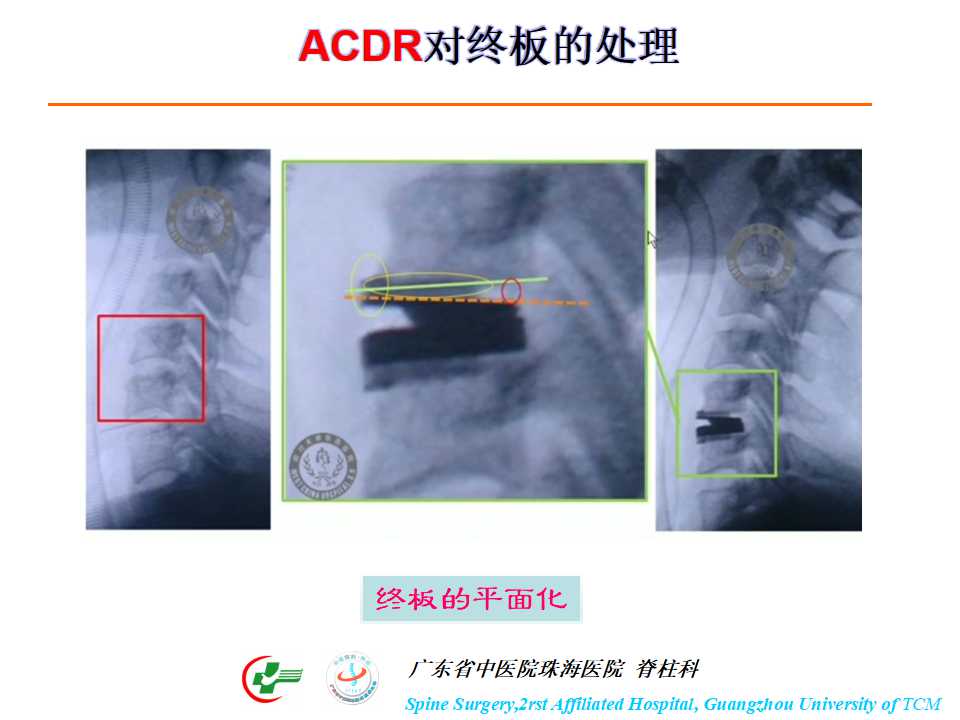 颈椎人工椎间盘在颈椎手术中的应用