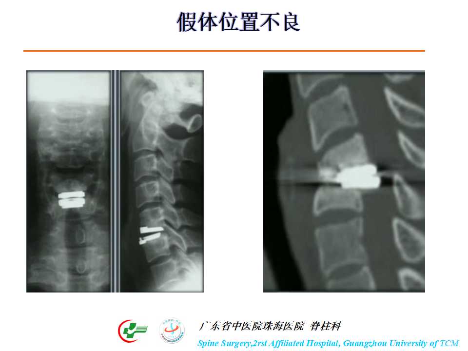 颈椎人工椎间盘在颈椎手术中的应用