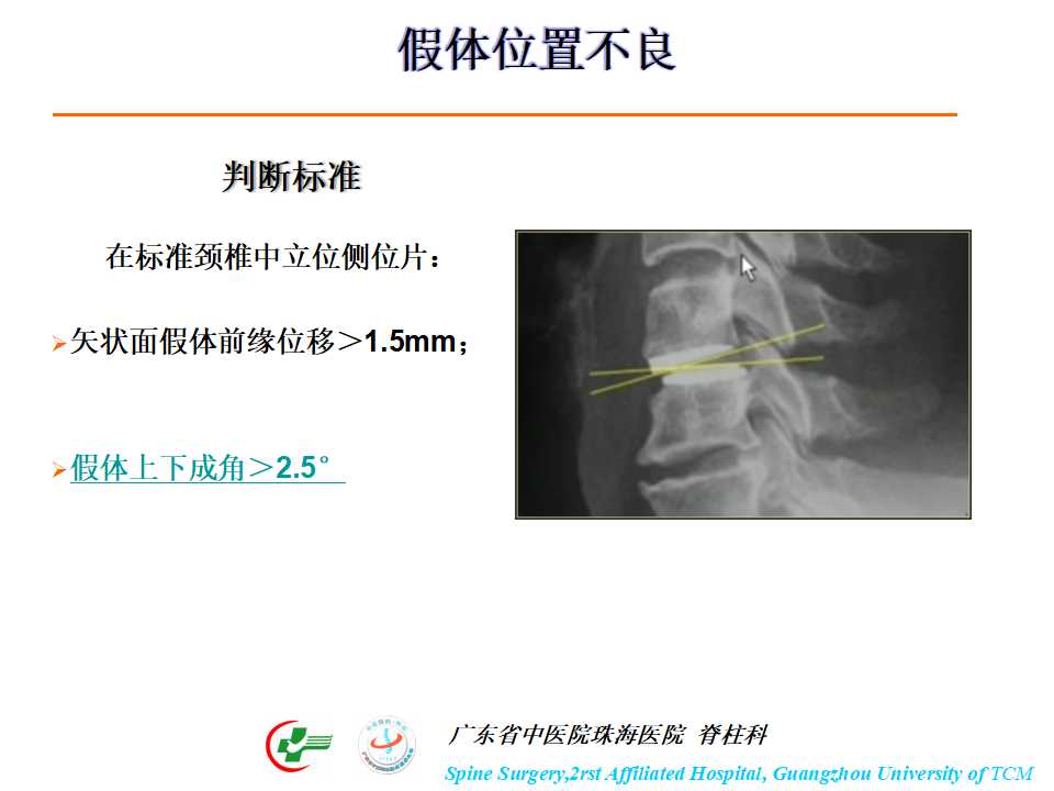 颈椎人工椎间盘在颈椎手术中的应用