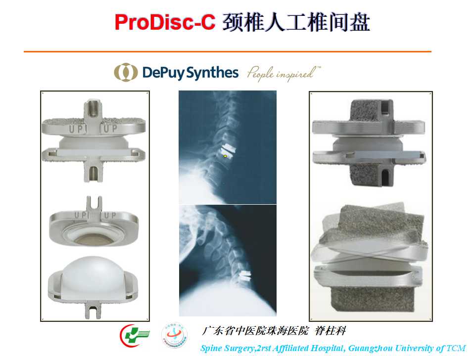 颈椎人工椎间盘在颈椎手术中的应用