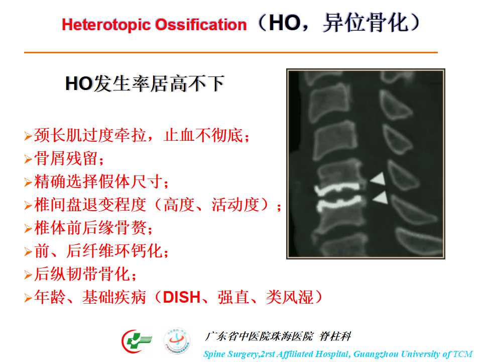 颈椎人工椎间盘在颈椎手术中的应用