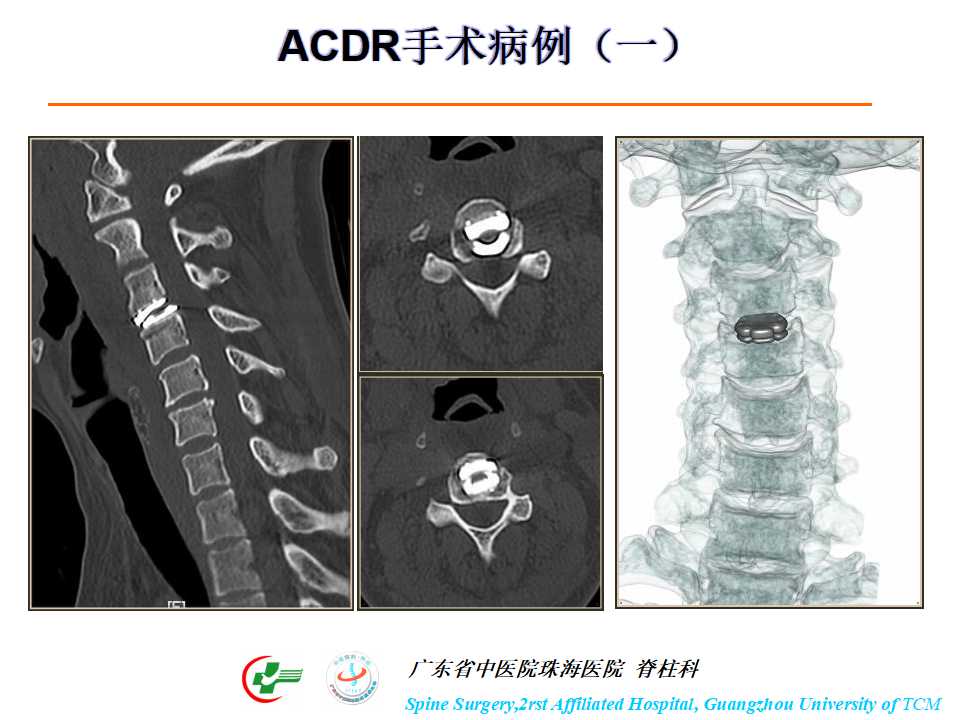 颈椎人工椎间盘在颈椎手术中的应用