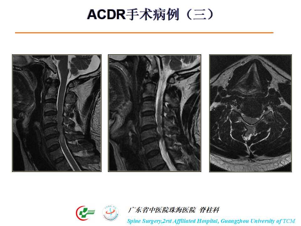 颈椎人工椎间盘在颈椎手术中的应用