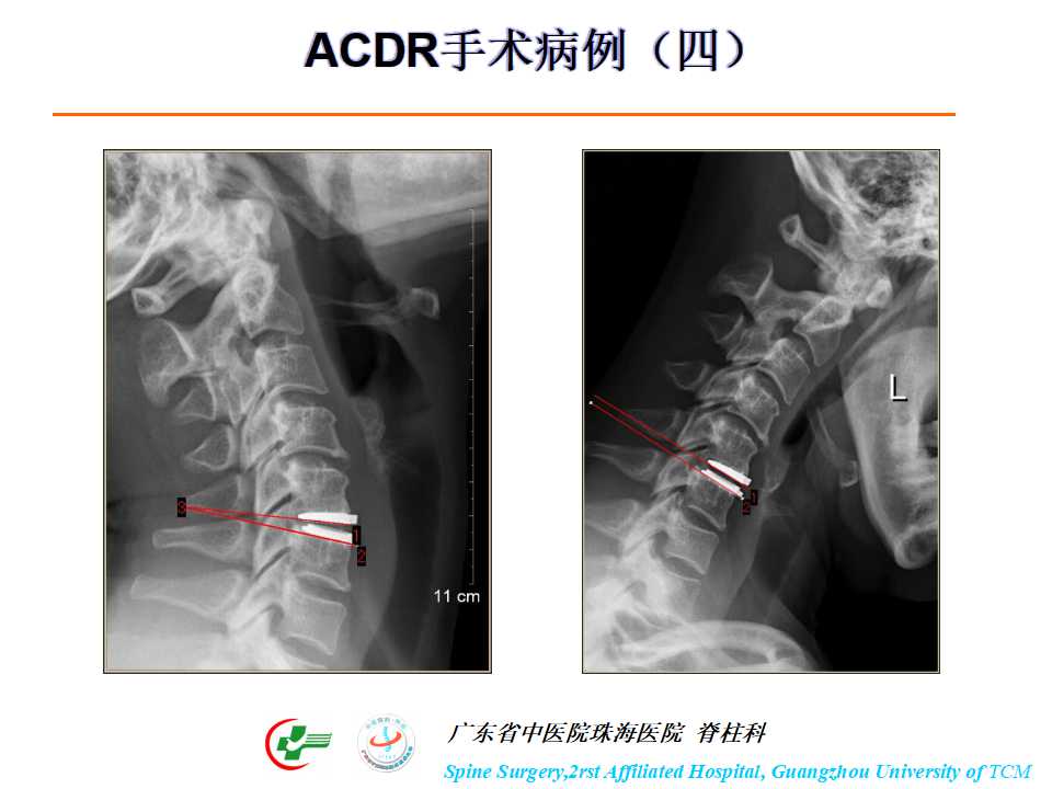 颈椎人工椎间盘在颈椎手术中的应用