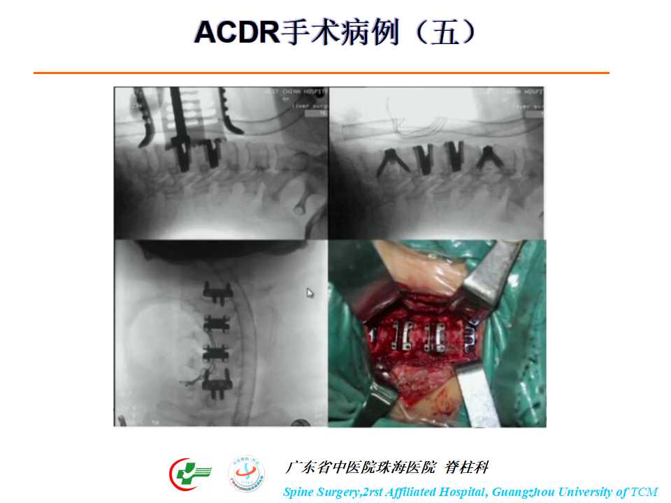 颈椎人工椎间盘在颈椎手术中的应用