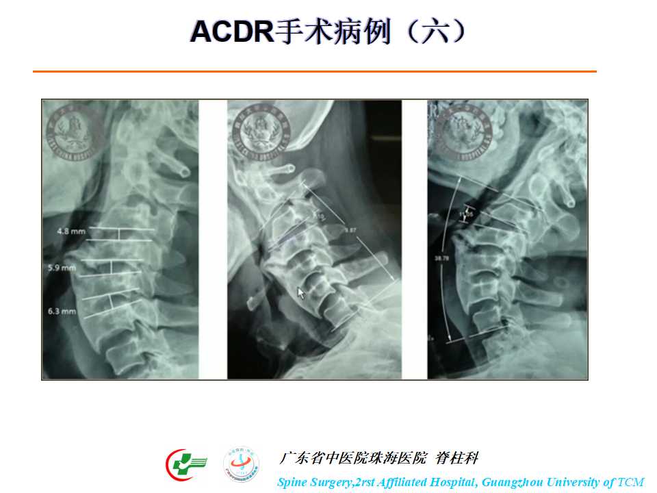 颈椎人工椎间盘在颈椎手术中的应用