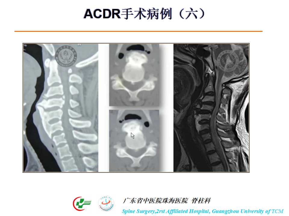 颈椎人工椎间盘在颈椎手术中的应用