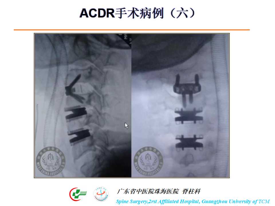 颈椎人工椎间盘在颈椎手术中的应用