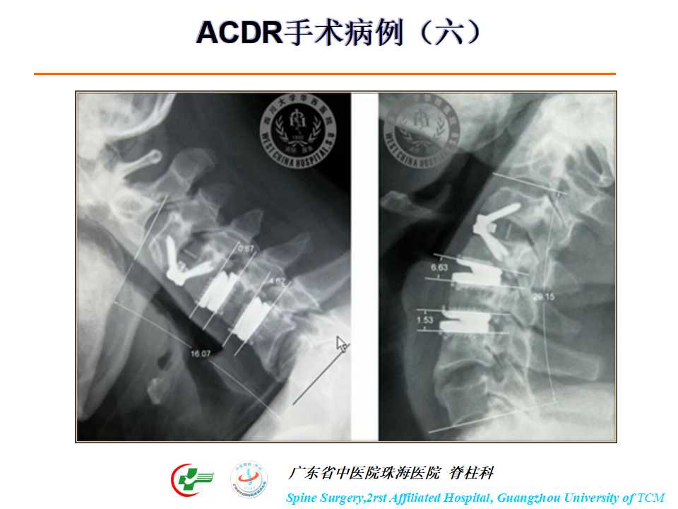 颈椎人工椎间盘在颈椎手术中的应用