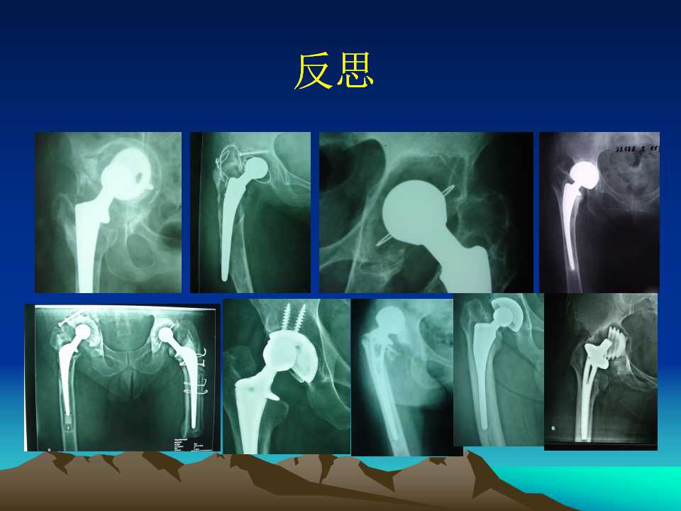 全髋关节翻修的原因及处理策略